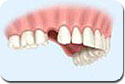Implantes