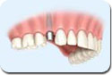 Implantes