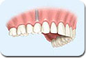 Implantes