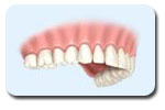 Implantes