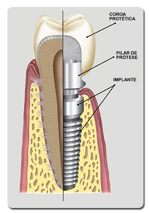 Implantes