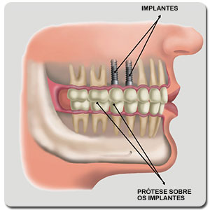 Implantes
